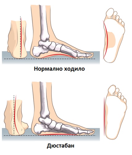 Плоскостъпие /дюстабан/