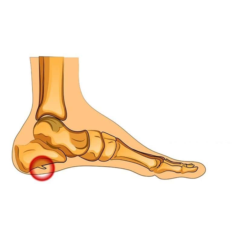 Как да намалите болката от шип на петата